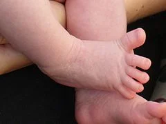 5. The Plantar Reflex (Babinski Reflex): Toe Tales of the Nervous System π£